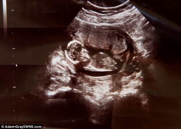 Siêu âm phát hiện ra còn một bào thai đang lớn lên trong tử cung của Michelle