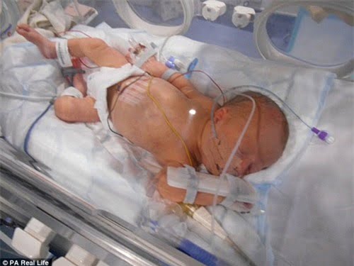 Em bé chào đời ở tuần 33 thai kỳ với một vết thủng ở ruột vô cùng nguy kịch.