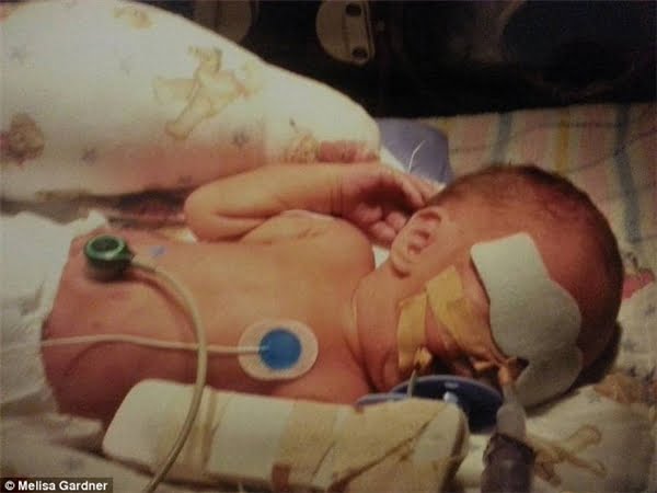 Melisa Gardner sinh Dwight sớm, ở tuần thứ 32 nên lúc lọt lòng, cậu bé chỉ nặng vỏn vẹn 2kg và cao 42cm. (Ảnh: Daily Mail)