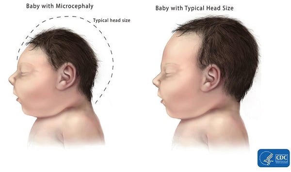 Hình ảnh trực quan về kích cỡ não và đầu của trẻ bị bệnh đầu nhỏ so với trẻ thường.