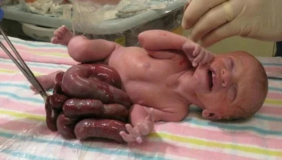 Ruột nằm ngoài ổ bụng của Teddy khi em chào đời. Ảnh: Daily Mail